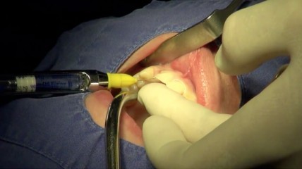 Vom Implantat bis zur Krone mit Dr. Christian Blum: Insertion mit Sofortbelastung