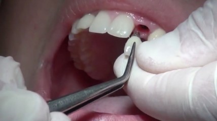 Vom Implantat bis zur Krone mit Dr. Christian Blum: Die Verblendkrone