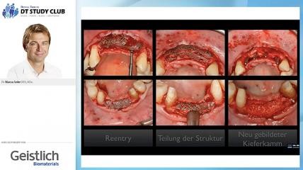 Live-Webinar zu Customized Bone Regeneration