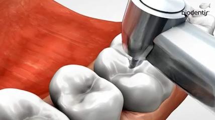 biodentis: Präparationsregeln zu Inlays und Teilkronen