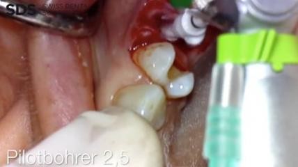 Insertion von Balkonimplantaten in Regio 25+26