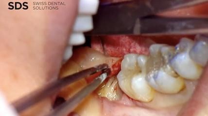 Behandlung einer ischämischen Osteonekrose im Unterkiefer