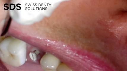 Alternative Entfernung einer Verschlussschraube bei SDS-Implantaten