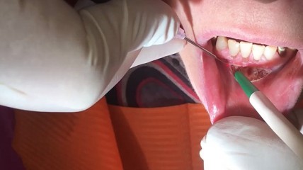 Vestibulumplastik mit dem Diodenlaser BluLase