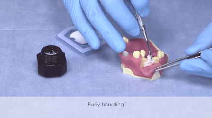 Guided Bone Regeneration mit creos xenogain und creos xenoprotect