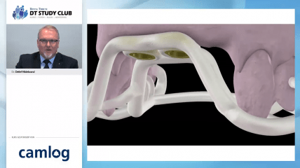 Webinar des Monats: Die Sofortversorgung mit COMFOUR™