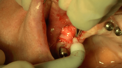 Oralchirurgische Membranfixation durch Smartact Titan Pins