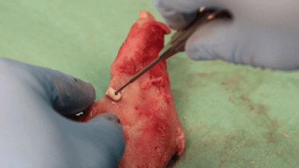 Bone-Management-Systeme für eine kontrollierte Anlagerungsplastik