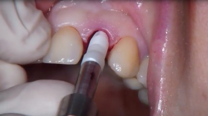 Live-OP mit Dr. Karl Ulrich Volz: Keramik ist einfacher – aber anders
