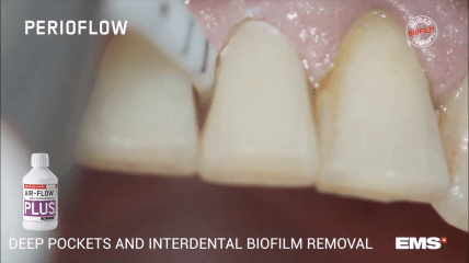 PERIOFLOW® in Aktion – Professionelle Reinigung der Interdentalräume