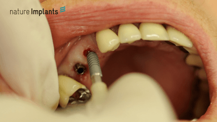 Einteilige Implantate von Nature Implants