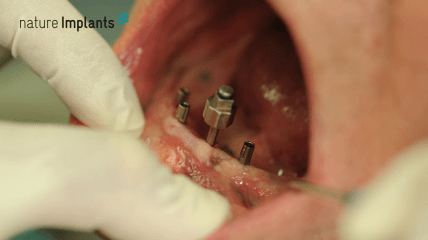 Zahnersatz in 14 Tagen mit Nature Implants