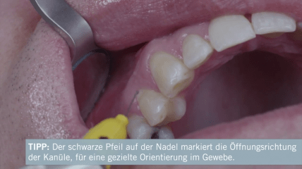 Tipps & Tricks zur Intraligamentären Anästhesie (ILA)
