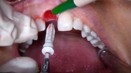 Live-OP: Sofortimplantat Region 11 mit Sofortversorgung