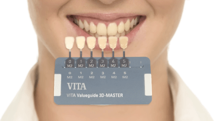 VITA Zahnfabrik: easy shade taking – Zahnfarbe nehmen mit VITA Linearguide