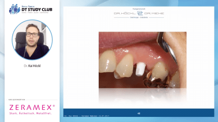 ZERAMEX® Webinar: Versorgung mit ZERAMEX® Keramikimplantaten