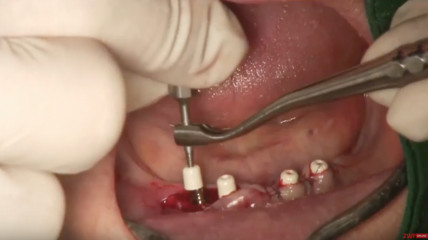 CAMLOG Live-OP „Das iSy Implantatkonzept – Reduktion der Behandlungszeit“