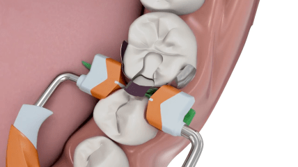 Composi-Tight® 3D Fusion™: Teilmatrize für erfolgreiche Kompositrestaurationen