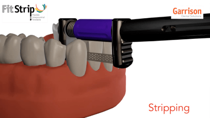 FitStrip™ – Finier- und Konturiersystem zur Gestaltung von Approximalkontakten
