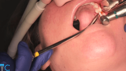 Demonstration der einfachen Implantation eines Keramikimplantates von Z-Systems