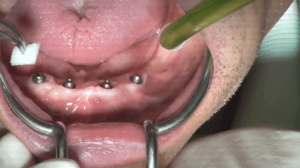 Video der Live-OP: „Das COMFOUR® Konzept – Teil 2“