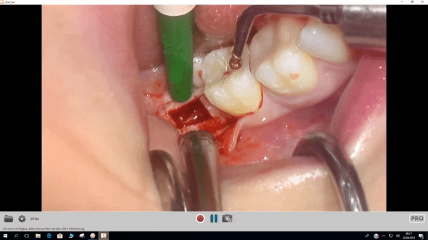 Video der Live-OP: Das SDS ALL-IN-ONE-CONCEPT – Teil 2
