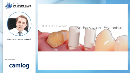Webinar des Monats: Das Münchener Implantatkonzept im digitalen Workflow