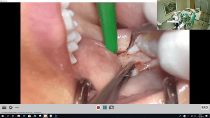 Video der Live-OP: Das SDS ALL-IN-ONE-CONCEPT – Teil 5