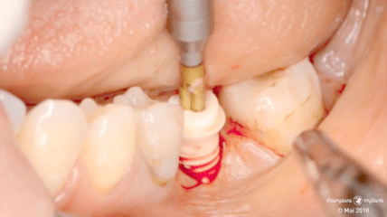 Einsetzen eines zweiteiligen BioWin! Keramik-Implants im Unterkiefer