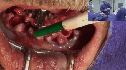 Video der Nobel Biocare Live-OP: Das All-on-4® Behandlungskonzept