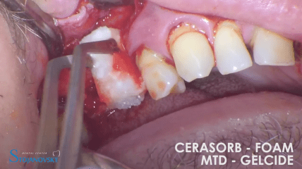 Komplikationsmanagement bei Perforation des Sinus Maxillaris