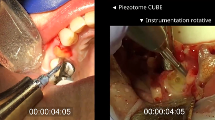 Schonende Zahnextraktion mit Hilfe des Piezotome CUBE