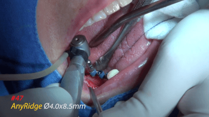 Implantatinsertion mit dem AnyRidge Implantat