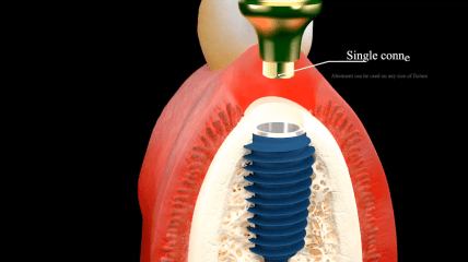 AnyRidge Implantat – Die Innovation auf dem Dentalmarkt