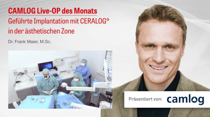 Video der CAMLOG Live-OP zur geführten Implantologie mit CERALOG®