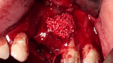 Video des Dentsply Sirona Live-Tutorials mit Dr. Ponte