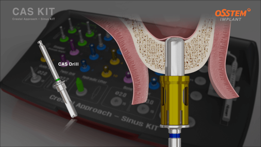 CAS-KIT – Bohrer-Kit für den internen Sinuslift – ZWP online – das ...
