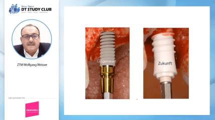 Dentalpoint Webinar: Prothetische Versorgungen auf ZrO2-Implantaten