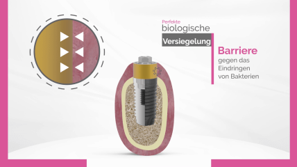 BioBlock® – Erfolgreich implantieren, Periimplantitis vermeiden