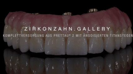 Komplettversorgung aus Prettau® 2 mit anodisierten Titanstegen