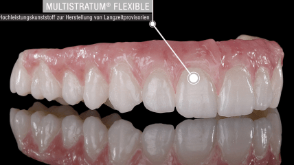 Digitaler Workflow, implantatgetragene Komplettversorgung aus Prettau® 2
