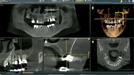Video des SDS-Webinars „Floating Implants“ – Keramikimplantate mit dem „BISS“