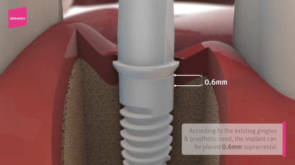 Die korrekte Insertionstiefe eines Zeramex XT Implantats