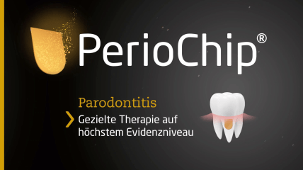 Webinar – Was Sie schon immer zu PerioChip® wissen wollten