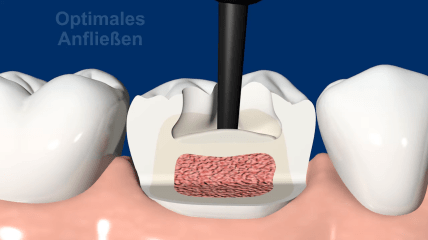 VisCalor bulk – Thermoviskoses Bulk-Fill-Composite