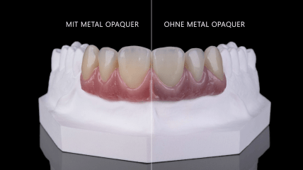 Metal Opaquer – Komposite zur Grundierung von Metallgerüsten