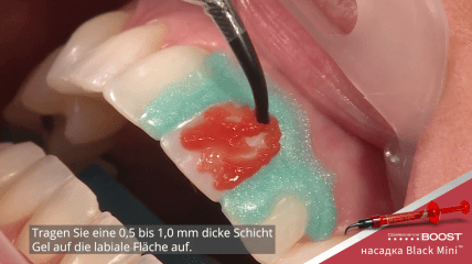 Step by Step: Medizinische Zahnaufhellung mit Opalescence™ Boost