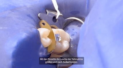 Verwendung des Halo™ Teilmatrizensystems