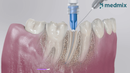 Endo Spül- und Absaugkanülen von Medmix Deutschland