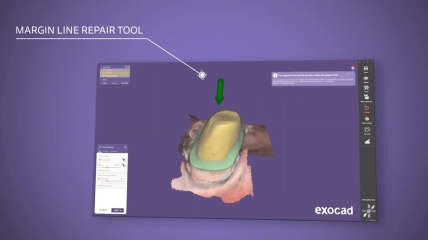 New DentalCAD 3.2 Elefsina - Now Available
